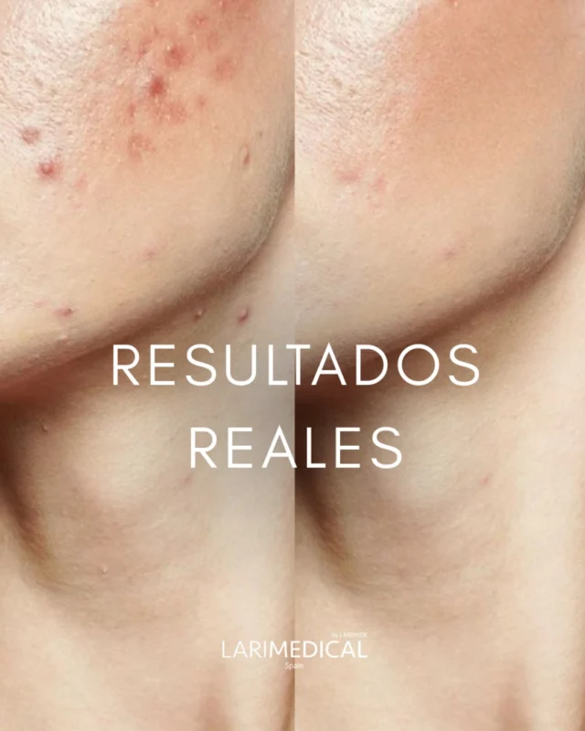 Hoy os mostramos uno de nuestros casos de éxito con Comedopeel Serum ✨

Este tratamiento ha demostrado ser eficaz en el manejo del acné y sus cicatrices. Gracias a su fórmula específica, se logra una mejora significativa en la textura de la piel, reducción de imperfecciones y control de la producción de sebo.

Lo que hemos logrado: 

🔹 Menos marcas residuales de acné
🔹 Piel más uniforme y suave
🔹 Control de nuevos brotes

Un ejemplo claro de cómo Comedopeel Serum puede ser una solución efectiva para quienes buscan tratar tanto el acné activo como las cicatrices que deja en la piel, todo desde la comodidad de su hogar.

___

Today, we’re sharing one of our success stories with Comedopeel Serum ✨

This treatment has proven effective in managing acne and its scars. Thanks to its specific formula, it leads to significant improvements in skin texture, a reduction in imperfections, and control over sebum production.

What we've achieved: 

🔹 Fewer acne scars
🔹 Smoother and more even skin
🔹 Control of new breakouts

A clear example of how Comedopeel Serum can be an effective solution for those looking to treat both active acne and the scars it leaves behind, all from the comfort of your home.

#Comedopeel #TratamientoAcné #CicatricesAcné #PielRenovada #CuidadoDeLaPiel #SkincareLovers #Acné #PielSana #CosméticaAvanzada #SkincareRoutine