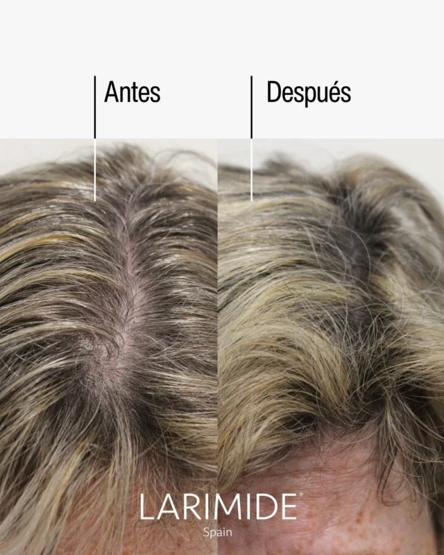 Kojaxin no es un simple sérum capilar. Es ciencia aplicada al crecimiento del cabello.

Su eficacia está avalada clínicamente en hombres y mujeres con pérdida capilar, de entre 18 y 65 años, mediante el sistema TrichoScan® , tecnología que mide la densidad y evolución del cabello con precisión milimétrica.

Resultados reales, medidos y comprobados:

➡️ Aumenta la densidad:
A los 45 días, el 50 % de los voluntarios notó el cabello más denso.
A los 150 días, lo hizo el 90 %.

➡️ Reduce la caída:
A los 45 días, el 88 % vio disminuir la caída.
A los 150 días, más del 90 % lo confirmó.

Y lo más contundente: el 100 % se mostró satisfecho y repetiría ✅.

No promete milagros. Entrega resultados.

--

Kojaxin is not just another hair serum. It’s science applied to hair growth.

Its effectiveness is clinically supported in men and women aged 18 to 65 with hair loss, using the TrichoScan® system — a technology that measures hair density and progression with millimetric precision.

Real, measured, and verified results:

➡️ Increased Density:
At 45 days, 50% of participants noticed fuller hair.
At 150 days, this figure rose to 90%.

➡️ Reduced Hair Loss:
At 45 days, 88% saw a reduction in hair shedding.
By 150 days, over 90% confirmed continued improvement.

And most convincingly: 100% were satisfied and would use it again ✅. 

It doesn’t promise miracles. It delivers results.

#Kojaxin #Larimide #cosmética #capilar #beautytech #anticaida
